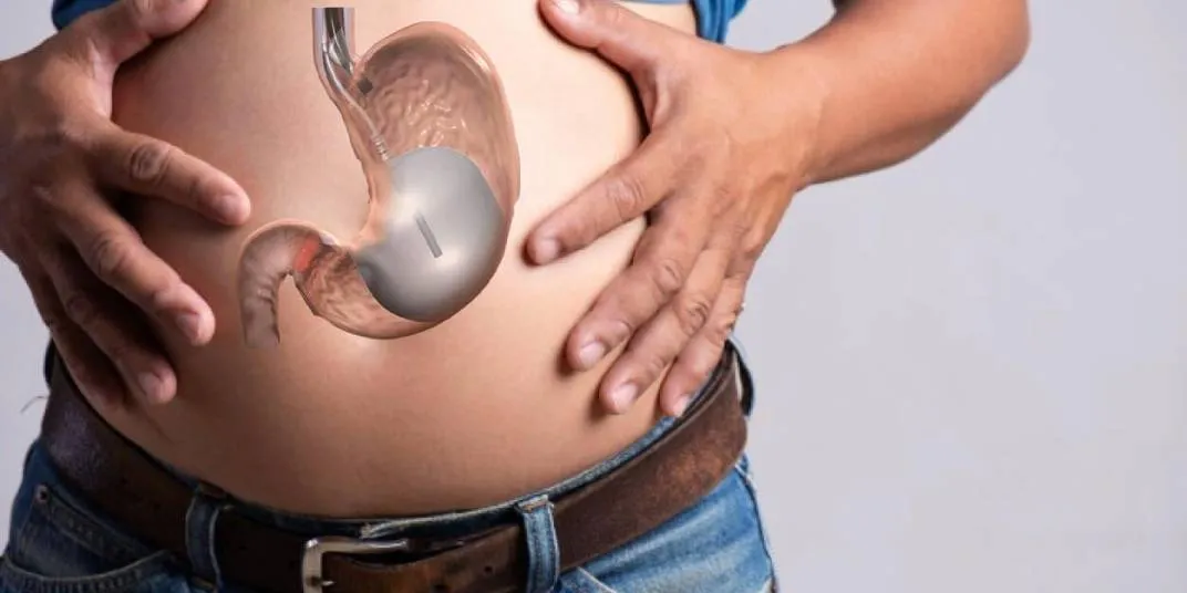 Intragastric balloon procedure for weight loss