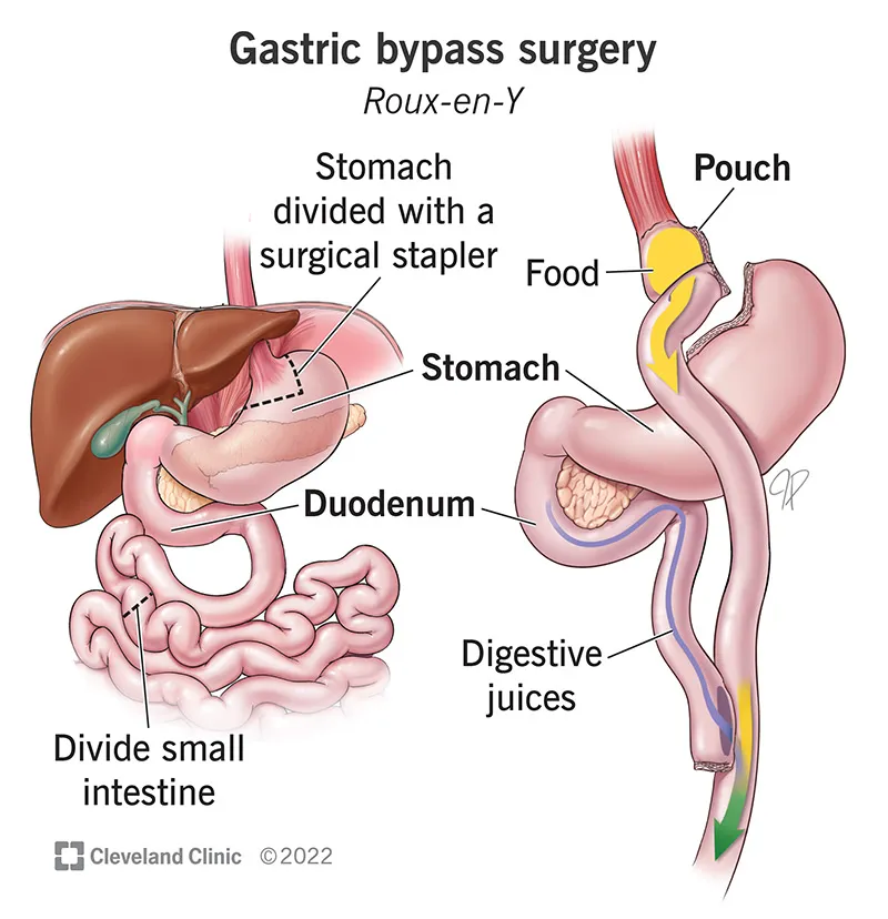 Gastric-Bypass2