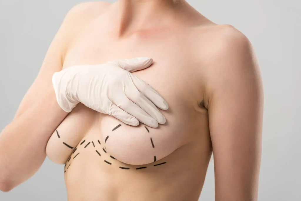 breast lift scars