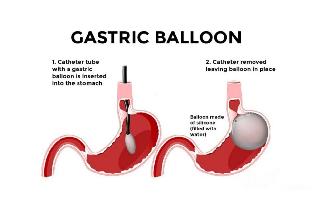 gastric-ballon