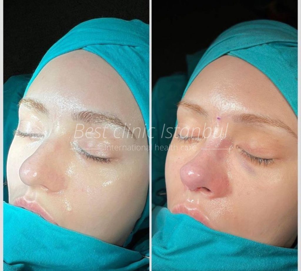 Rhinoplasty before and after photos showcasing nose transformations