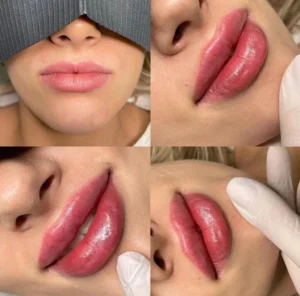 Overview of lip fillers, including cost, duration, and before-and-after results