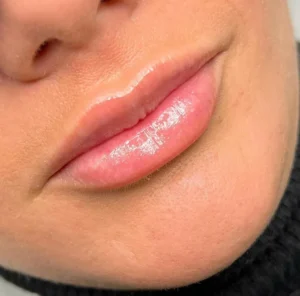 Overview of lip fillers, including cost, duration, and before-and-after results