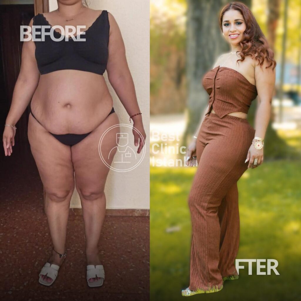 tummy tuck before and after