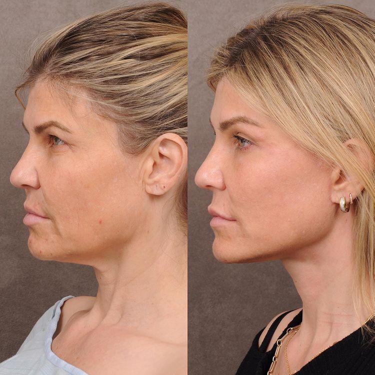 Advanced cosmetic surgery