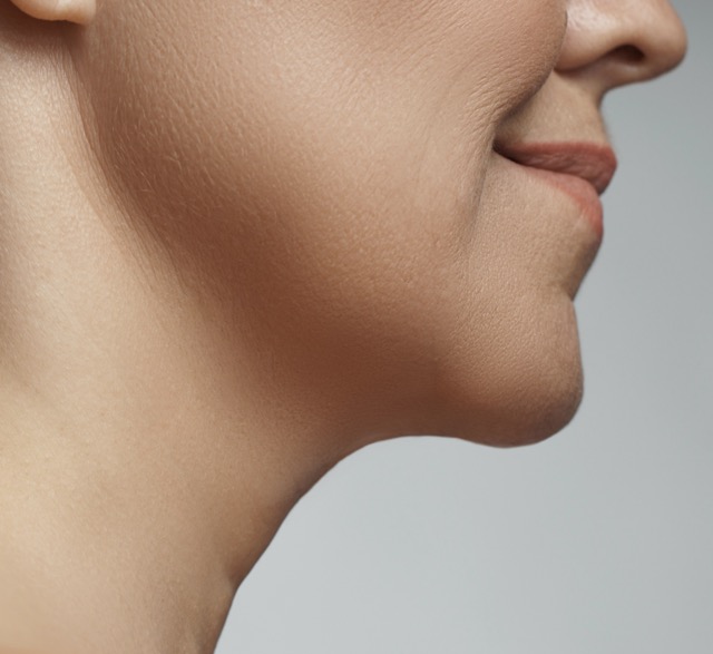 Chin Liposuction