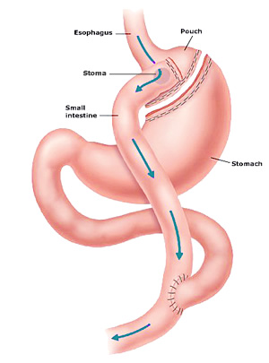 gastric bypass