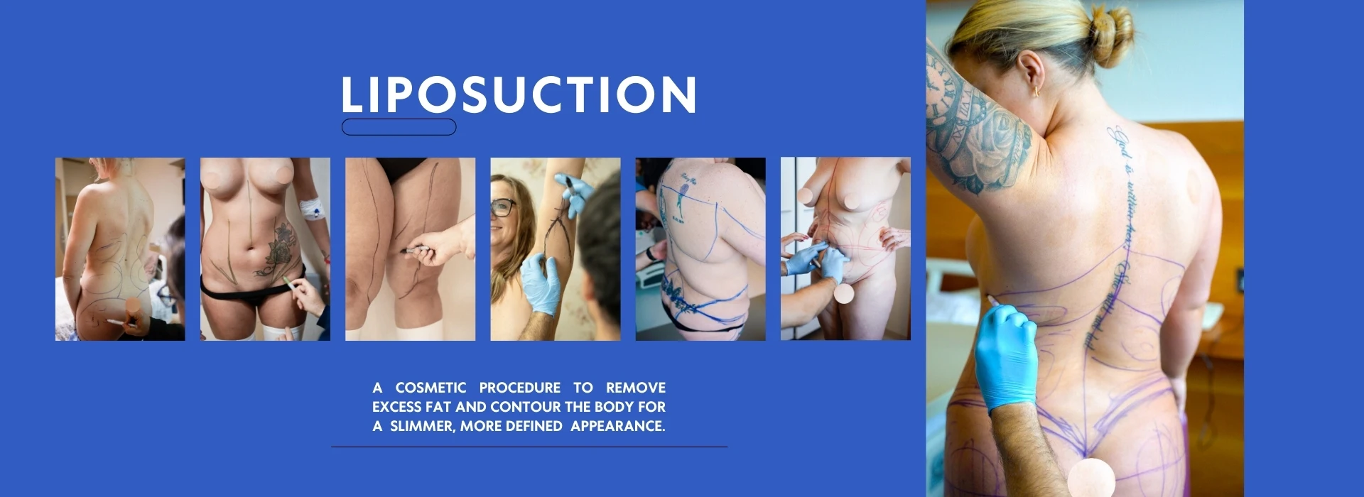 Liposoction