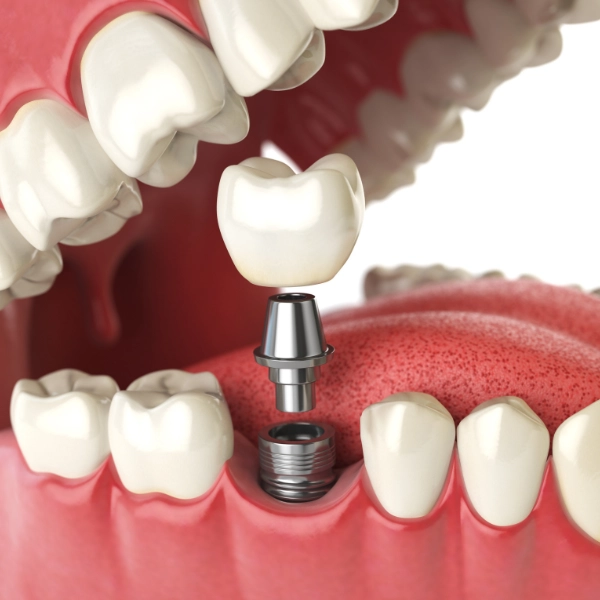 /dental-implants/