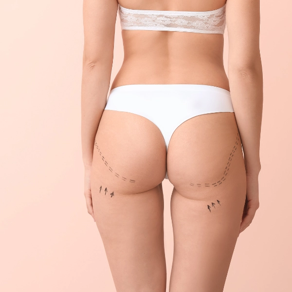 /brazilian-butt-lift/